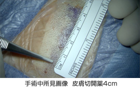 手術中所見画像 皮膚切開薬4cm