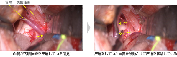福島式手術方法